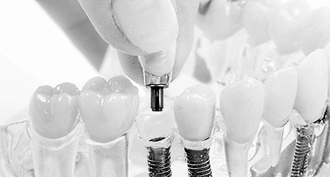 Foto: Zahnimplantate